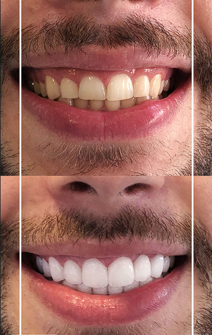 Before and after photo of a real cosmetic dentistry smile transformation